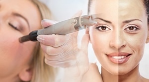 ISPEGLAJTE BORE uz prirodni botox - iglična MEZOTERAPIJA botopeptidima u Medelina Health Studiu u Zagrebu uz dr. Sanju Jeleković!