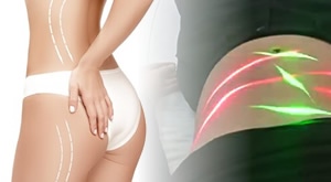 [SPECIJALNA PONUDA] Potpuna TRANSFORMACIJA tijela uz revolucionarni Maxlipo Master Slim LASER, Tesla uređaj, Butt Lift i presoterapiju u Bio+Klinik salonu u Zagrebu već od 49 €!