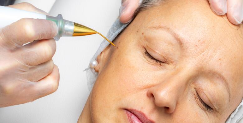 Uklanjanje bradavice, keratoze ili fibroma inovativnim tretmanom PLASMA PEN u Bio+klinik kozmetičkom salonu